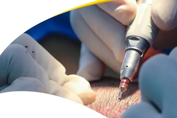 بهترین زمان کاشت مو | چه فصلی برای کاشت مو مناسب‌تر است؟